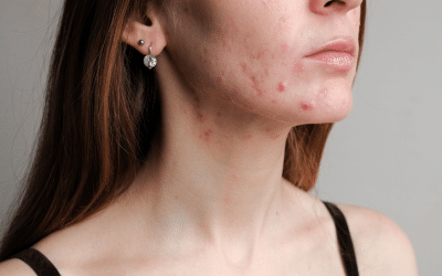 Beyond the Surface: A Holistic Approach to Managing Acne